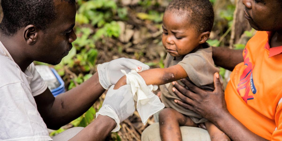 A majomhimlő Afrikára jellemző zoonózis, emberről-emberre nehezen terjedő fertőzés