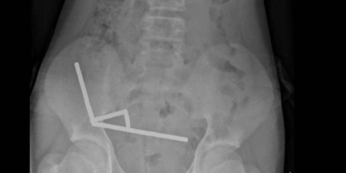 Röntgenfelvételen az összetapadt mágnesek az új-zélandi tinédzser hasüregében.