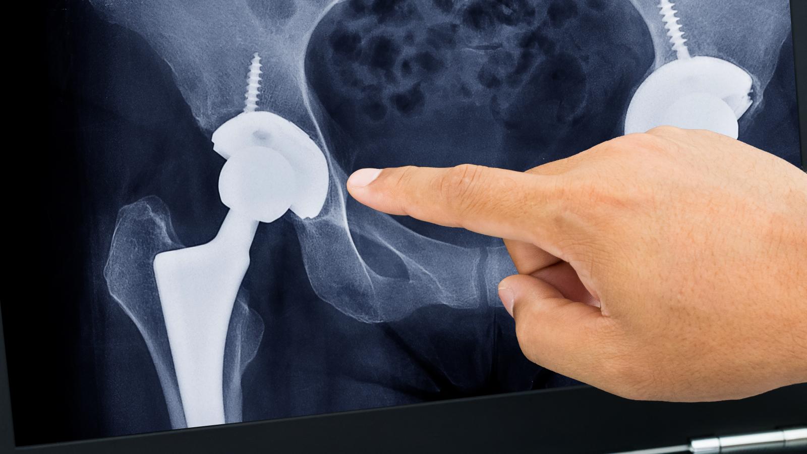 A magyar beteg sokáig csak interneten kerül protézis közelébe