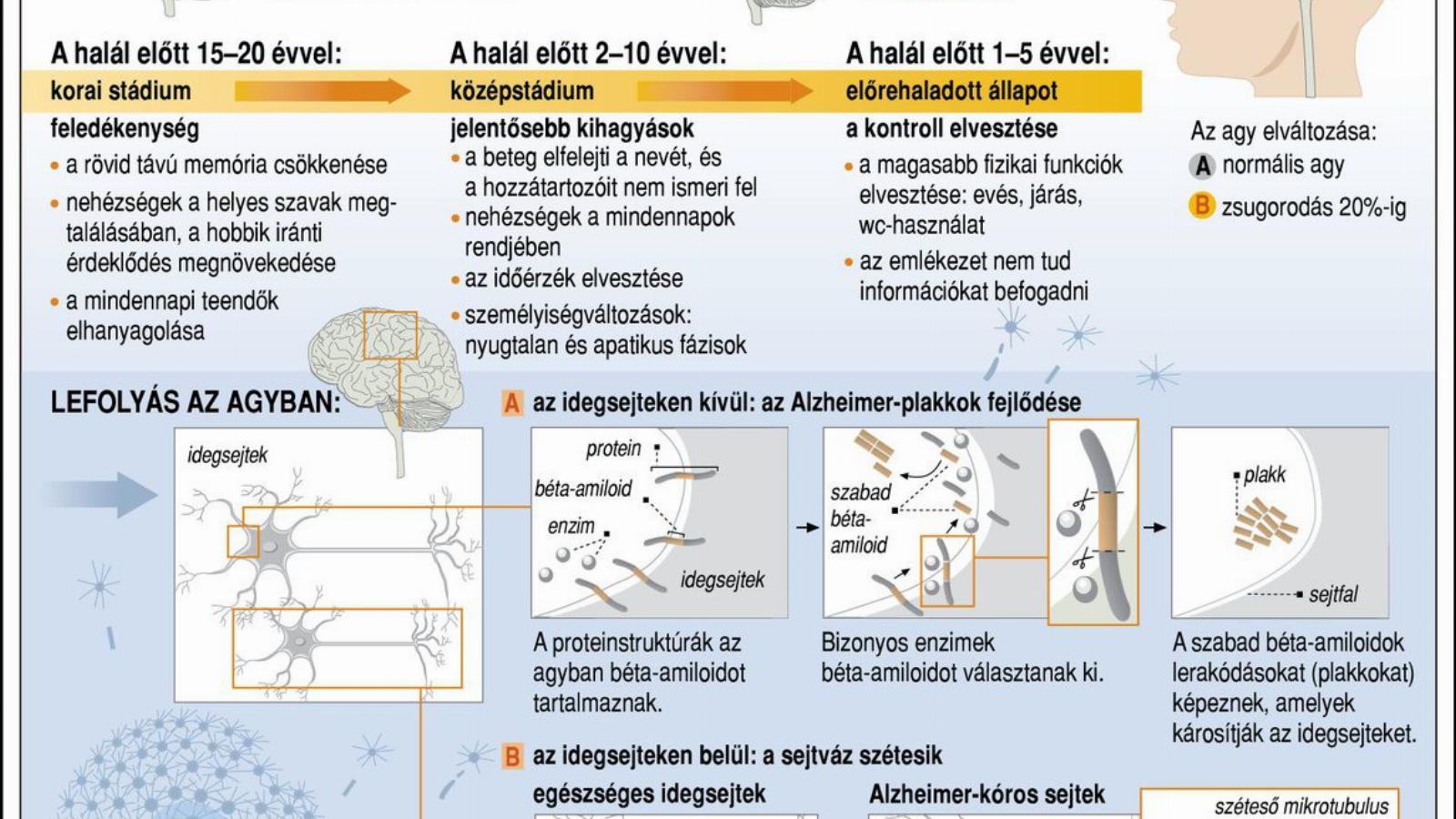 Az Alzheimer-kór a felejtés betegsége; az ábra a betegség lefolyását ismerteti. Forrás: MTI